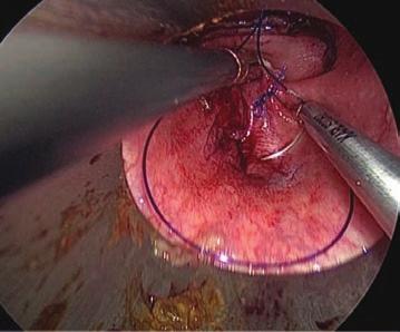 colorectal leak into the pelvis (bubbles)