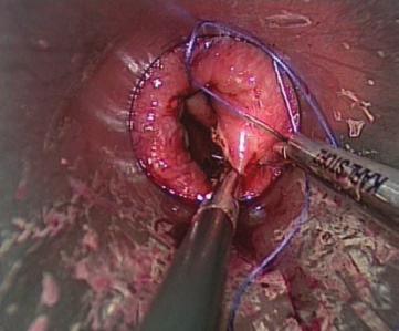 the circular benign stenosis