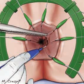 Total Mesorectal Excision (TME) from
