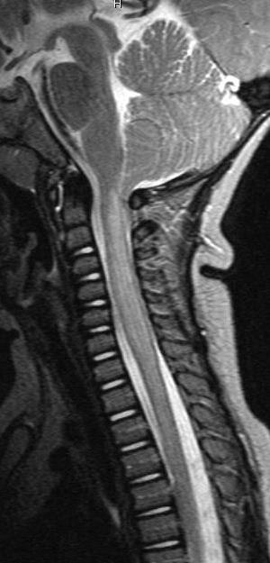 Spinal Trauma Long segment spinal cord edema Axial loaded associated