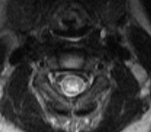 reveal spinal cord edema extending from the foramen magnum to C7 level