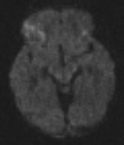temporal lobe, right temporal pole, anterior frontal