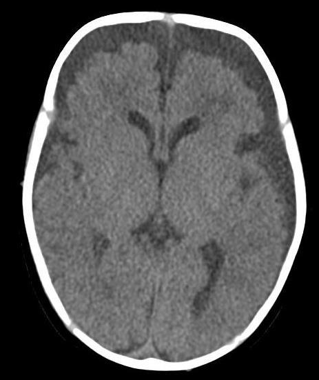 3-Month-Old with Seizures and Periorbital Bruising 1 2 3 4 Figs 1