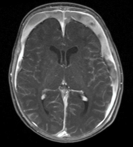 3 & 4) reveal extensive subdural enhancement with pial irritation