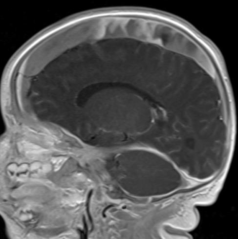 arrows) Teaching Point: Patients with diffuse atrophy from