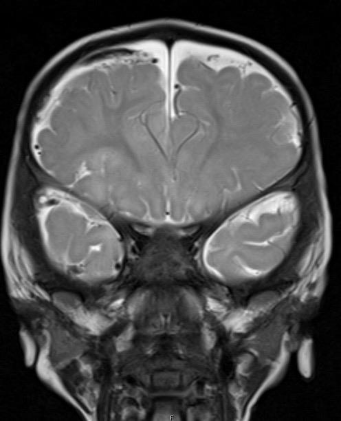 10 Month Old with Seizures 1 2 3 Fig 1shows bilateral, frontal