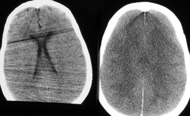Diffuse Brain Swelling (Dysautoregulation vs Hypoxia) 1 2 Initial CT scan (Fig 1) read as Normal.