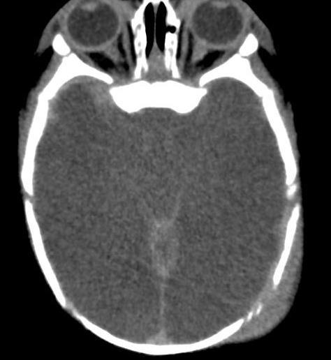 effacement of the ventricles and sulci Teaching Point: Even when imaging clearly shows