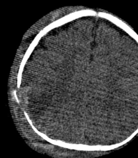 3-Month-Old with Right Parietal Trauma 1 2 3 Initial CT Fig 1shows