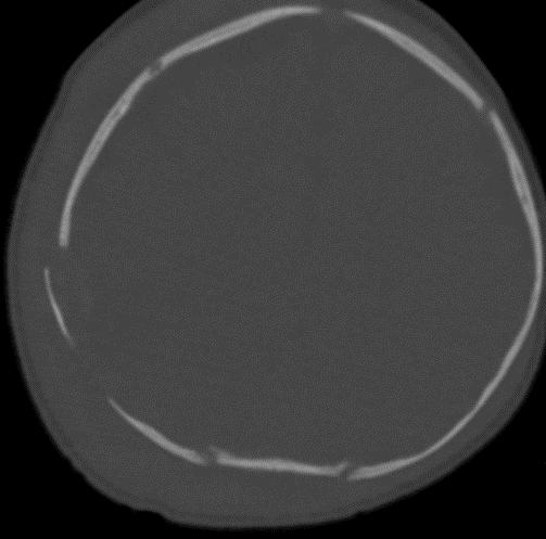 displaced right parietal bone fracture (yellow arrows in Fig 2) and a