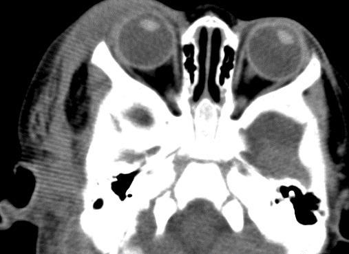 This wedge-shaped defect in the pariental lobe in association with high