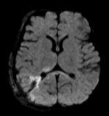 3-Month-Old with Right Parietal Trauma MRI follow up 3