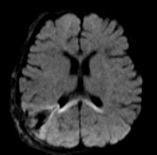 wedge-shaped defect extending from the right parietal