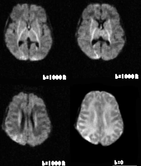 brain laceration (red arrow) Widespread cortical