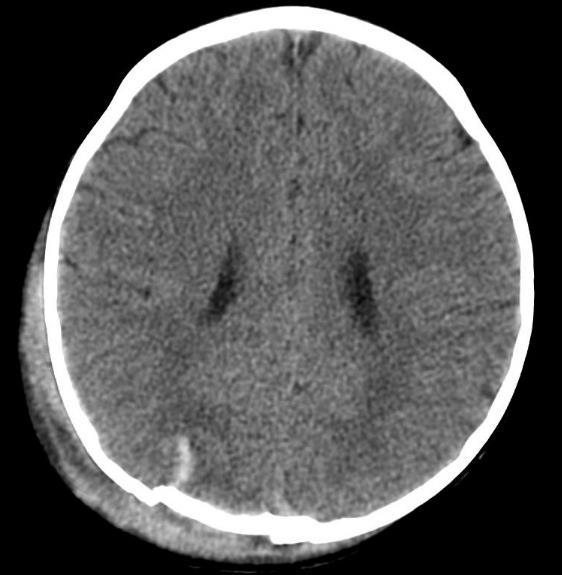 Fig 2 shows a small right cerebellar