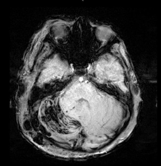 31 Month-Old Boy after Fall 1 2 3 Follow up MRI Fig 1 & 2 illustrate increased conspicuity of the brain