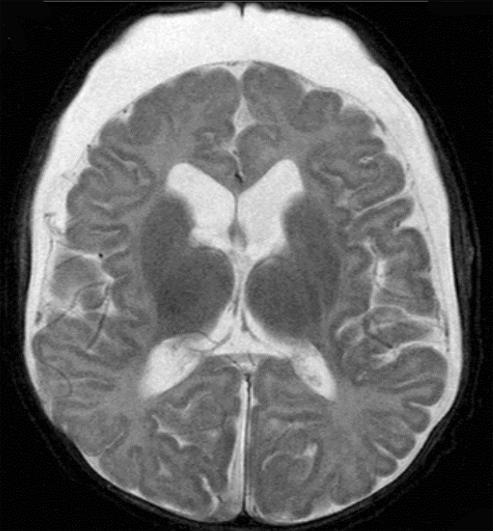 macrocephaly related to chronic subdural effusions (red arrows) producing an