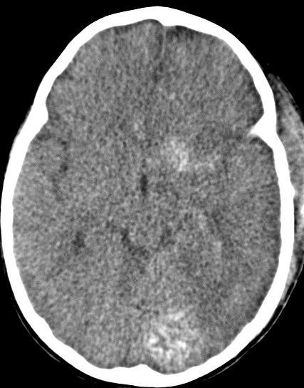 herniation (orange arrow) Non contrast CT