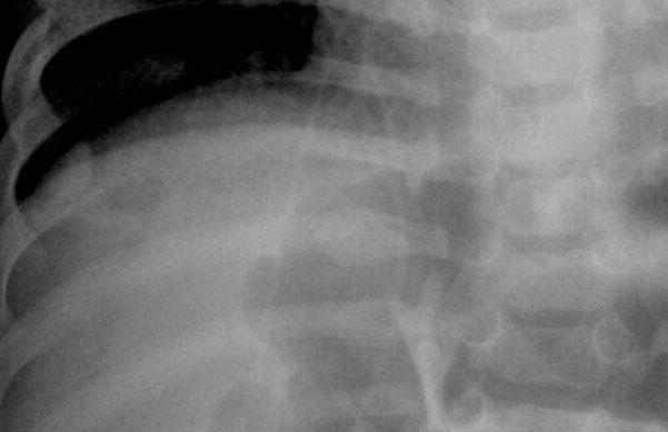 rib fractures (yellow arrows), better