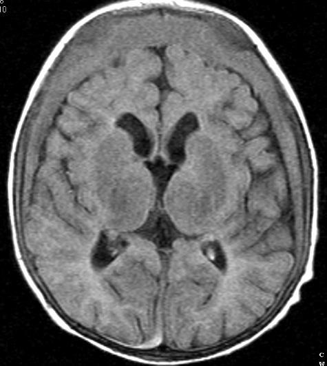 Traditional Radiology Teaching of Neuro NAT Prominent extra-axial spaces (between purple arrows) predispose for