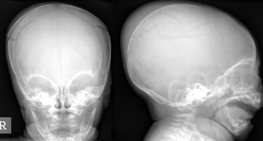 Fig 1 & 2 - Axial loaded skull