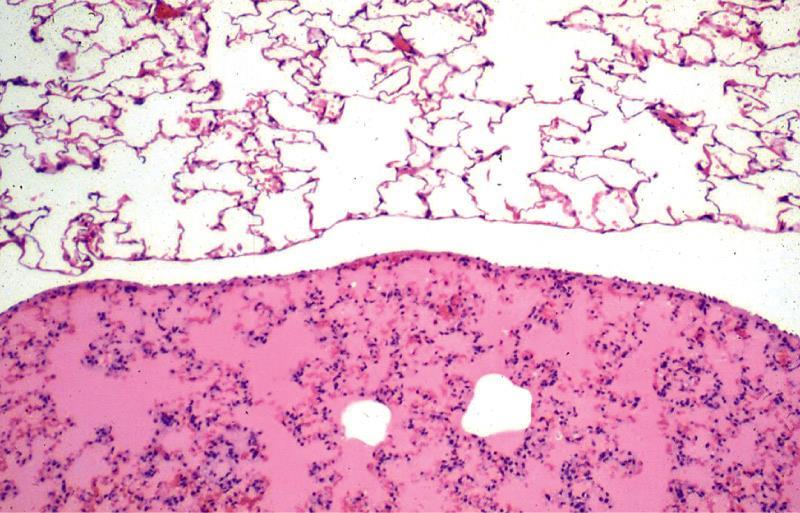Image: Zachary and McGavin PBVD EDEMA Histologic Appearance of Edema Lightly staining eosinophilic