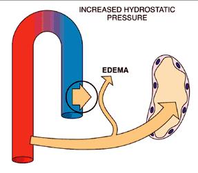 EDEMA - Pathophysiological Mechanisms of Development 1.