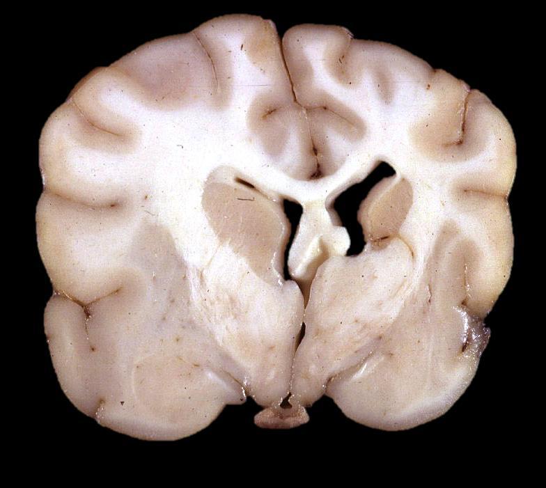 CEREBRAL EDEMA Causes Trauma to brain