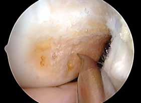 5. To create an ACL femoral tunnel located in the center of the ACL femoral attachment site, the center of the ACL femoral tunnel should be located at a shallow-deep position that is 50% of the