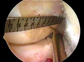 The proximal cartilage border represents the deep aspect of the ACL femoral attachment site. b. The length of the ACL femoral attachment site is determined at the shallow margin where the TRUKOR Gauge touches the articular cartilage border (Figure 14).