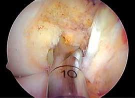 If the resulting ACL femoral tunnel length is significantly less than desired, it is possible to increase the femoral tunnel length by reversing the guide pin back to the entry point, angling the