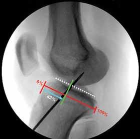 Figure 23 In general, the tip of the tibial passing pin should lay 1 2 mm anterior to the posterior margin of the anterior horn of the lateral meniscus and slightly medial to the mid-line of the ACL