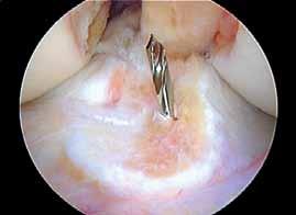 The most common error made when converting from the transtibial tunnel technique to the anteromedial portal technique is to position the tibial guide pin in the posterior half of the ACL tibial