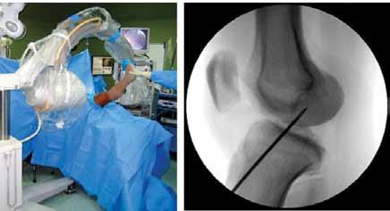 Note: Placement of the tibial guide pin posterior to the posterior margin of the anterior horn of the lateral meniscus will result in the ACL tibial tunnel being placed in the area of the tibial