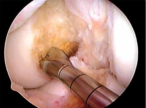 The ACL femoral tunnel is drilled independently of the tibial tunnel, which results in consistent placement of the femoral tunnel within the native ACL femoral attachment site. 2.