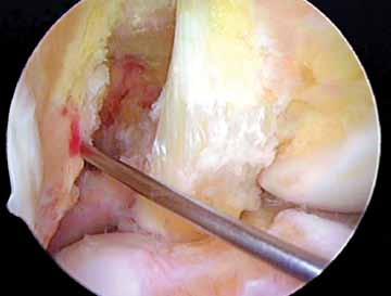 For example, if a bone-patellar tendon-bone ACL graft with interference screw fixation of the femoral bone block is