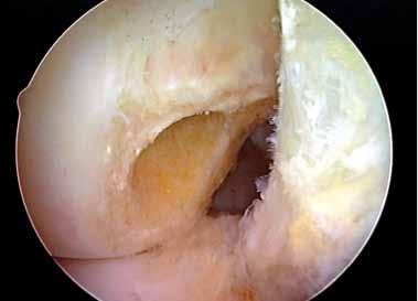 A 40 mm femoral tunnel allows for 25 mm of the hamstring tendon graft to be inserted into the ACL femoral socket when