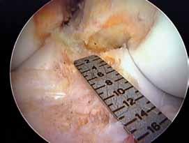 Rotate the arthroscope medially to determine if the needle is positioned too closely to the medial femoral condyle. Adjust the position of the portal accordingly. 2.