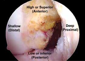 femoral attachment site through the AM portal. ACL femoral tunnel placement is more accurately defined and specified using the following methods: I.