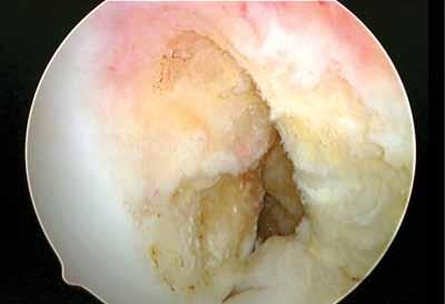 The view of the intercondylar notch and ACL femoral attachment site changes significantly depending on the arthroscopic portal utilized.