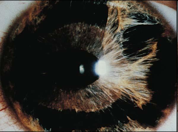 Essential Iris Atrophy Iris stromal loss with corectopia and ectropion uvea Iris hole