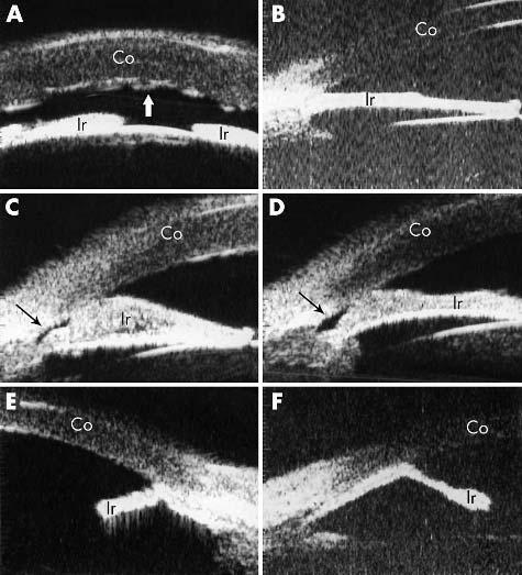 UBM and ICE syndrome 67 Figure 2 Ultrasound biomicroscopic (UBM) features of ICE syndrome.