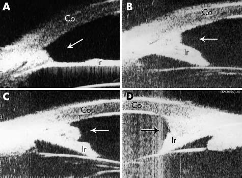 Folds of Descemet s membrane present a wave-like appearance (indicated by the white thick arrow). (B) Demonstrates the UBM image of a patient with progressive iris atrophy (patient 2).