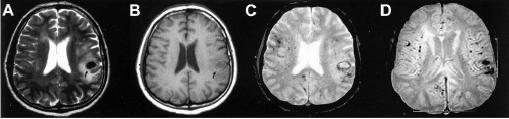 normal in approximately 40%; high probability in 40% Pathology Vasculitis of small and medium vessels of leptomeninges and underlying cortex with variable degrees of granulomatous changes Giant cells
