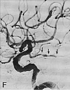 Spinal Fluid in PACNS Angiography in PACNS: