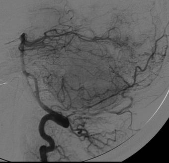 proven PACNS Of abnormal angiograms in PACNS,