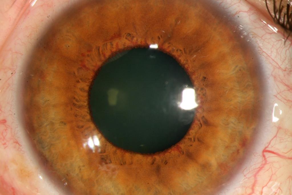 Ù Clinical profile v Pre glaucomatous stage v Open