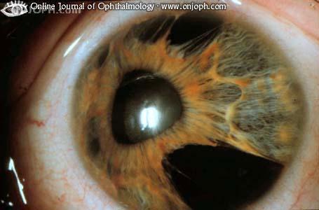 Ù 3 en66es v Progressive iris atrophy v Chandler s syndrome v Cogan Reese syndrome Ù Presence of abnormal