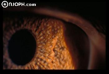Ù Clinical features Affects middle aged women v Progressive iris atrophy iris features predominates with corectopia, atrophy and hole forma6on v Chandler s syndrome Mild iris changes and corneal