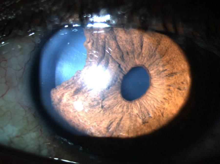 Ù Mechanisms v Inflammatory glaucoma due to iridocycli6s v Glaucoma due to intraocular haemorrhage v Lens induced glaucoma due to swollen lens v Angle closure glaucoma due to anterior